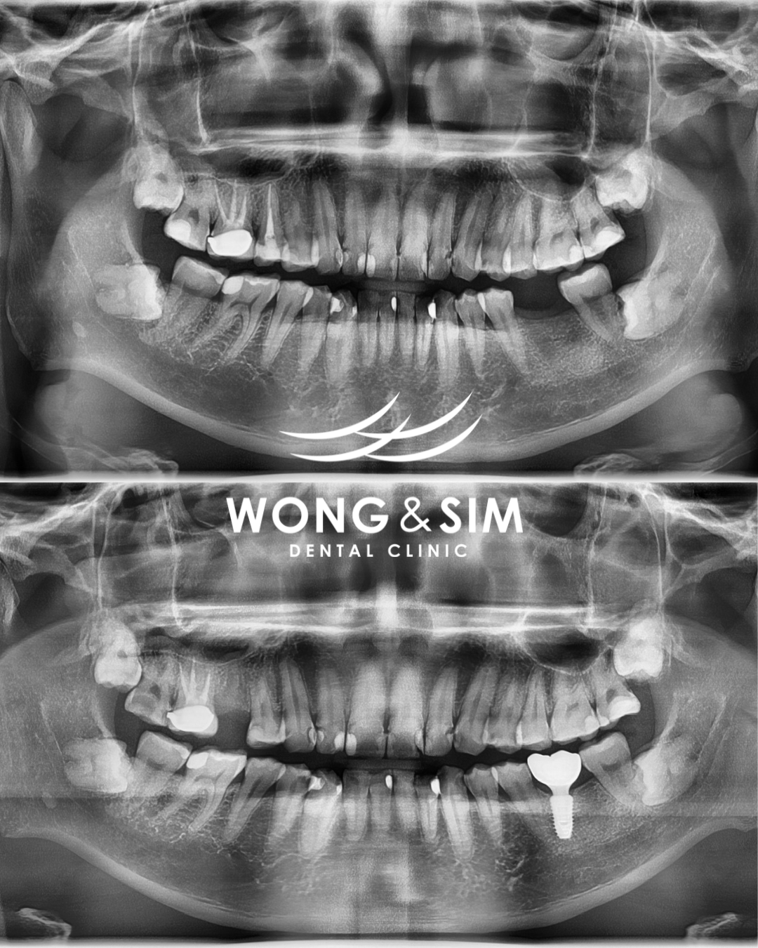 Implant Patient 5
