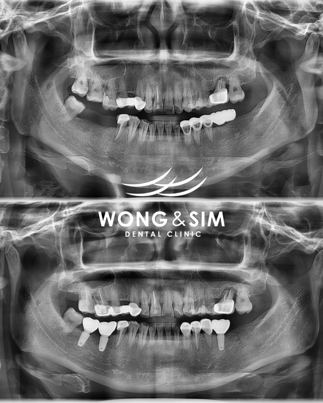 Implant Patient 6