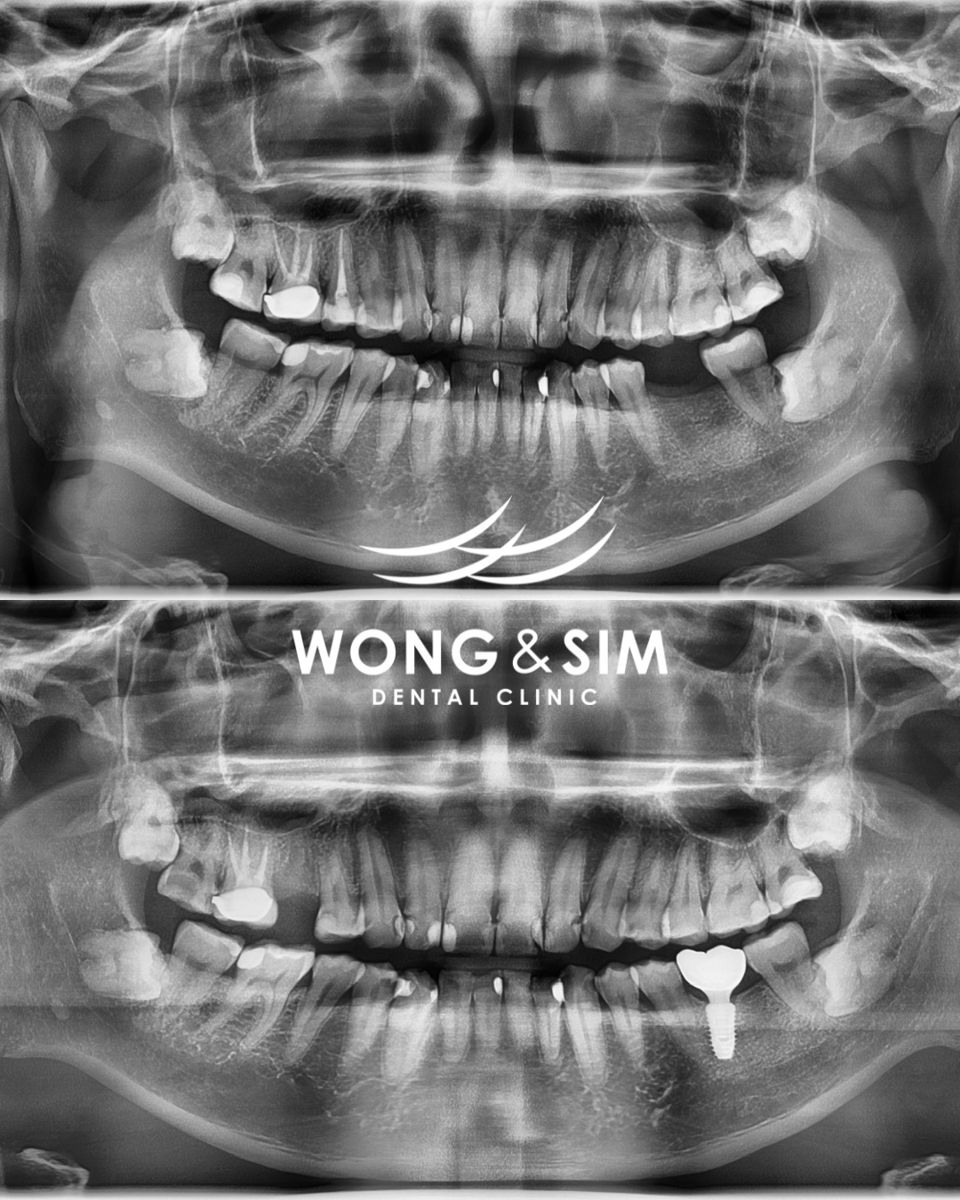 Implant Patient 7