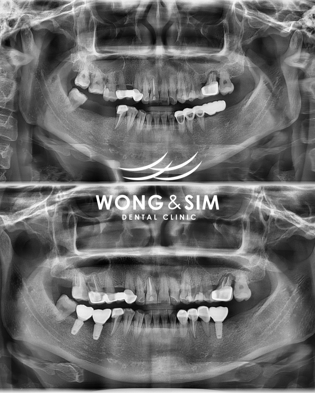 Implant Patient 9