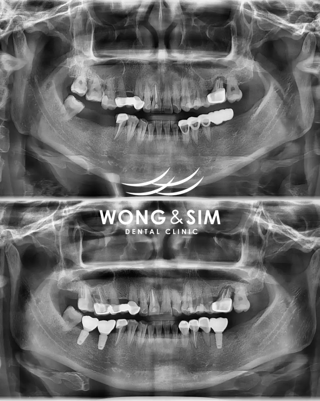 Implant Patient 3