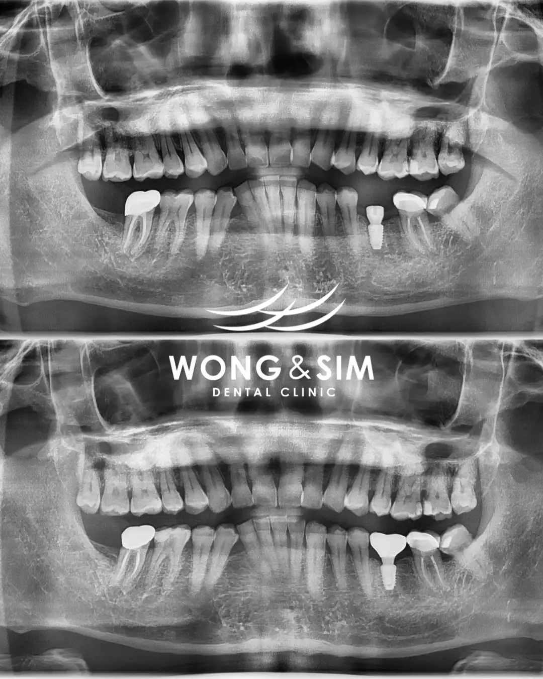 Implant Patient 4