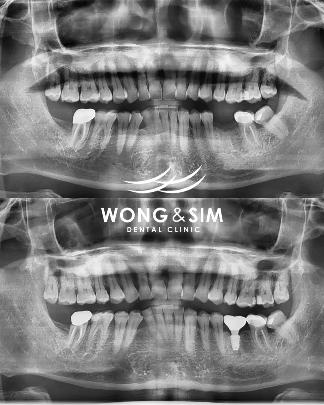 Implant Patient 1